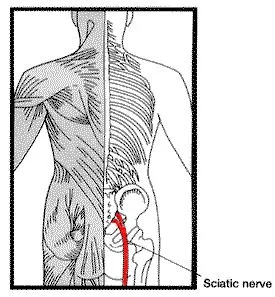 sciatica